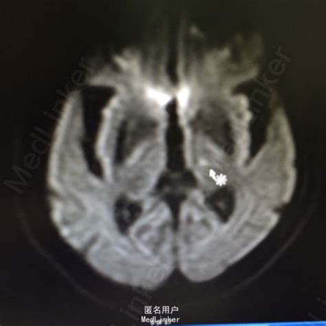 缺血性脑血管病伴多发脑梗塞