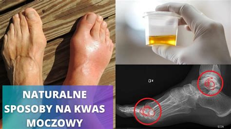 Obni Kwas Moczowy Naturalnymi Produktami Najlepsze Domowe Sposoby Cda