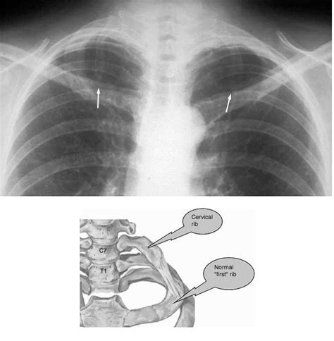 Medical Addicts: CERVICAL RIBS: X-ray