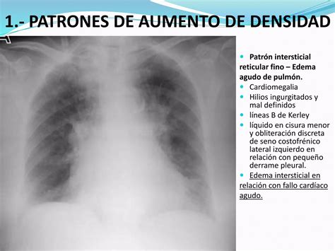 Principales Patrones Radiológicos En La Placa Simple De Tórax Ppt