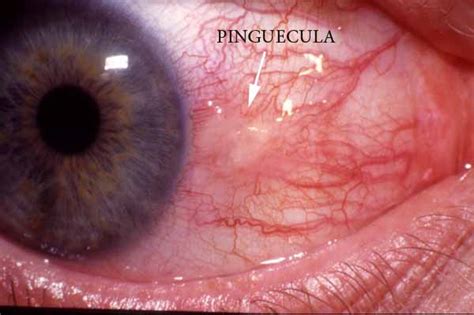 The Australian Pterygium Centre Do I Have A Pterygium Or Do I Have A