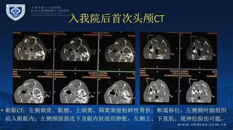 颅脑创伤 神经重症病例周刊（第25期）丨小儿合并严重颌面部外伤的开放性脑外伤治疗一例 搜狐