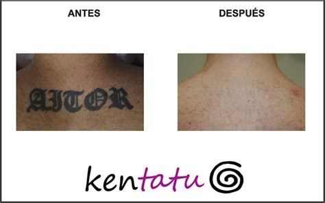 Eliminaci N De Tatuajes Con L Ser En Bilbao Kentatu