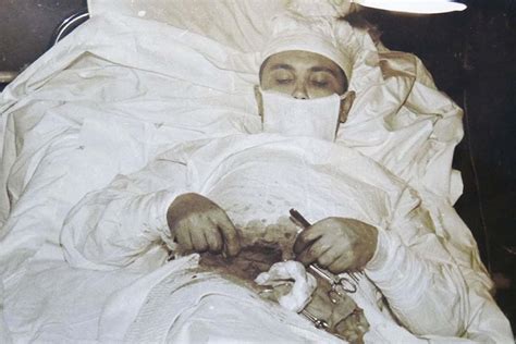 Dr. Leonid Rogozov operating on himself to remove his appendix in ...