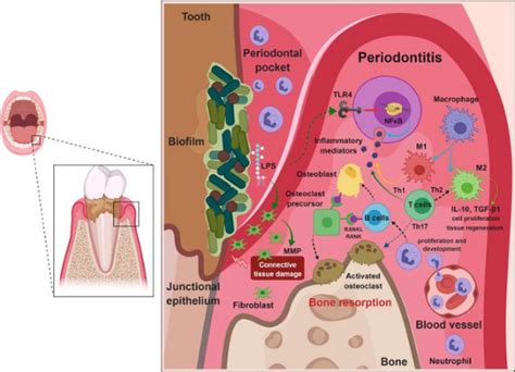 Pathogenesis Of Periodontal Diseases Dentalnotebook