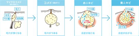 そのニキビは思春期ニキビ！？大人のニキビとの違いは何？｜吹田市・江坂のたまき皮フ科