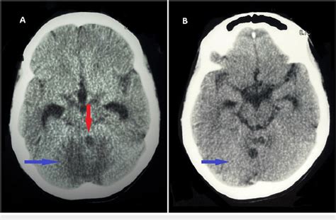 Ct Scan Of The Brain Plain A Axial View Showing Hypodense Lesion