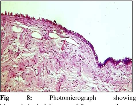 Figure From A Five Year Retrospective Study Of The Histomorphological