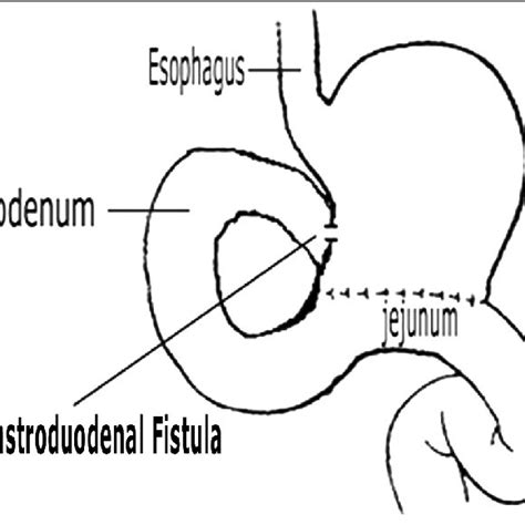 The View Of Antral Mass During Gastroscopy Download Scientific Diagram