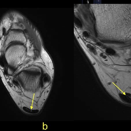 PDF MRI Of The Achilles TendonA Comprehensive Pictorial Review Part One