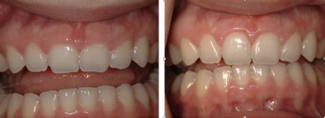 Periodontics Before And After Pictures Bellmore Ny Smile Gallery