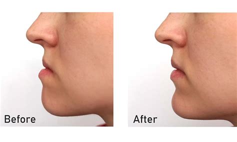 Corrective Jaw Surgery Jaw Orthognathic Surgery Elara Orthodontics