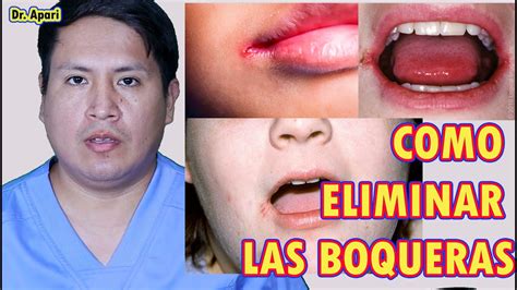 Como Eliminar Las Boqueras Dr Apari Youtube