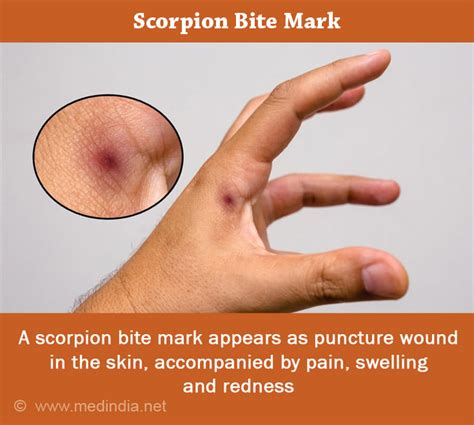 Scorpion Sting Symptoms Diagnosis First Aid And Treatment