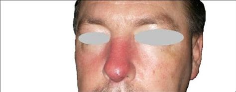 Nasal Cellulitis: Causes, Symptoms and Treatments - eCellulitis.com