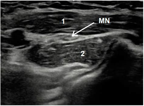 How to Differentiate Pronator Syndrome from Carpal Tunnel Syndrome: A