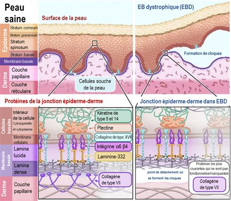 Épidermolyse Bulleuse Comment La Thérapie Génique Et Cellulaire Peut