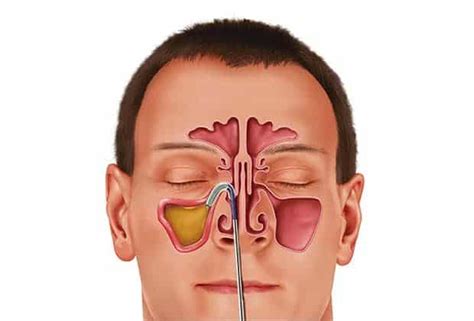 Balloon Dilation Chronic Sinusitis Treatment Portugal Resident