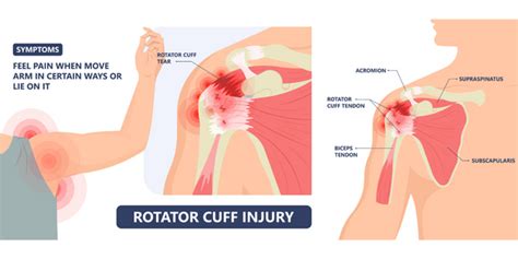 Shoulder Injury Diagram