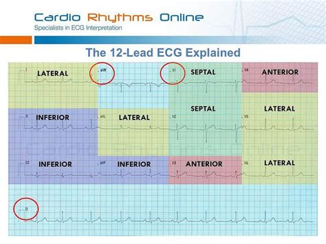 12 Lead Ekg Interpretation Cheat Sheet | Cheat Sheet