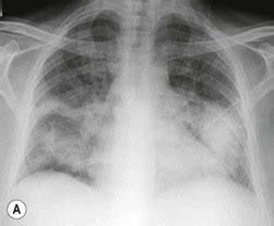 Airspace Diseases | Radiology Key