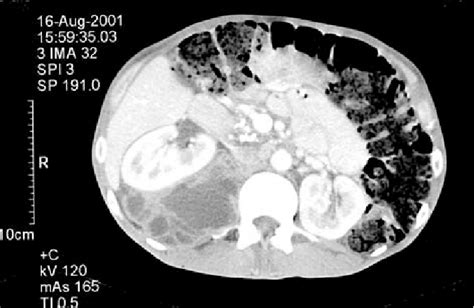 CT Scan Showing Right Large Iliopsoas Abscess With Anterior