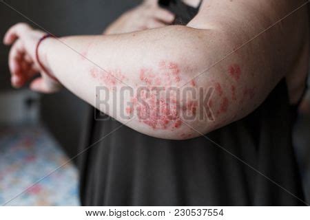 Psoriasis Skin. Image & Photo (Free Trial) | Bigstock