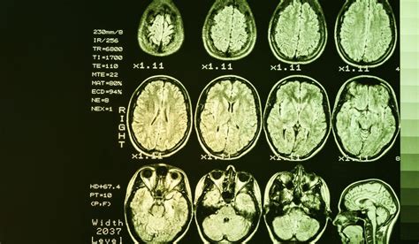 Earlier diagnosis and treatment of Dementia in Parkinson's - Cure ...