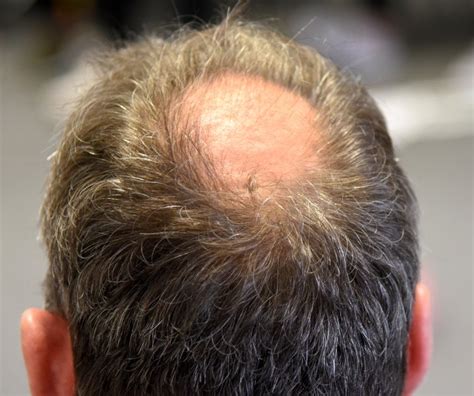 Wie Viele Grafts Bei Einer Haartransplantation Elithair