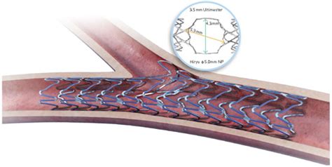 Ultimaster Drug Eluting Stent