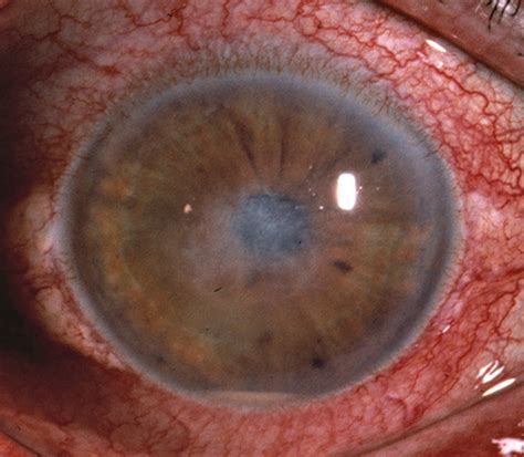 Microsporidial Stromal Keratitis Cornea Jama Ophthalmology Jama Network