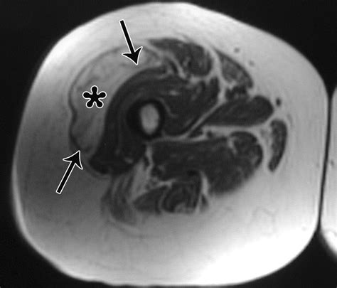 Imaging Of Musculoskeletal Liposarcoma With Radiologic Pathologic