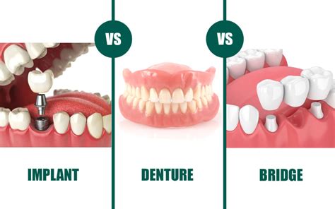 Are Implants Same As Bridges Or Dentures Royal Dental Clinics Blog