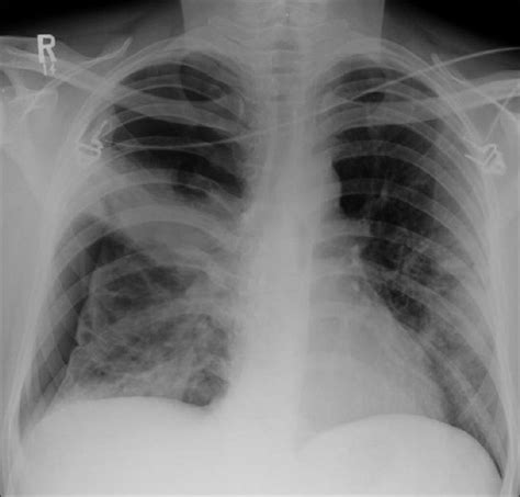 Pneumocystis Carinii Pneumonia Pneumothoraces Are Often Refractory To Download Scientific