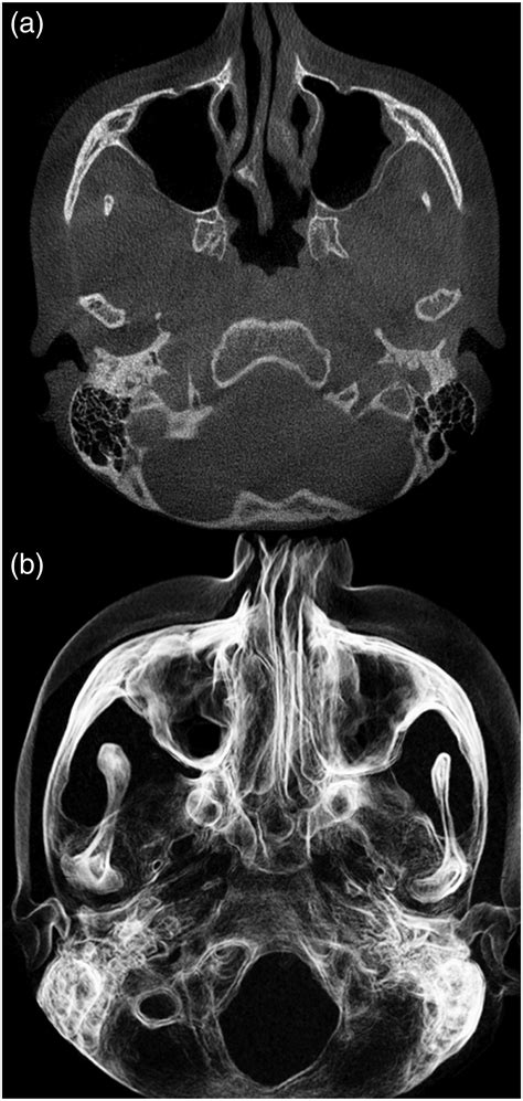 Tmj Contrast Enhancement In Cbct Images Using A New Algorithm Mar A