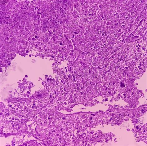 Thyroid Cancer Microscopic Image Of Follicular Neoplasm Malignant