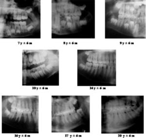 Las radiografías dentales en la estimación de la edad cronológica