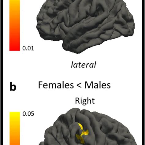 The Figure Shows Differences In Local Gyrification Index In Patients