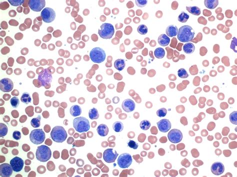 Pathology Outlines Chronic Myeloid Leukemia CML BCR ABL1 Positive