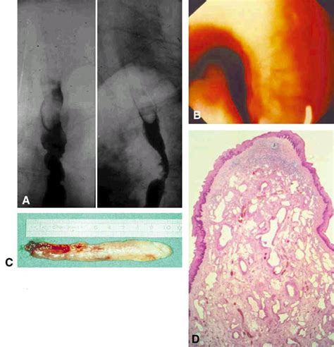 Fibrovascular Polyp Of The Esophagus Gastrointestinal Endoscopy