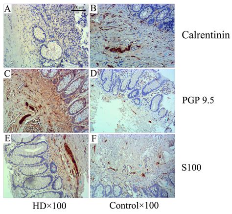 Diagnosis Of Hirschsprung S Disease By Immunostaining Rectal Suction