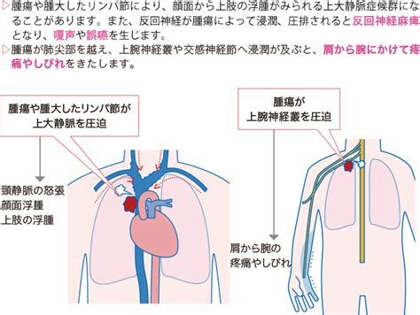 上大静脈症候群画像 | 上大静脈症候群 ステント治療 – NDJI