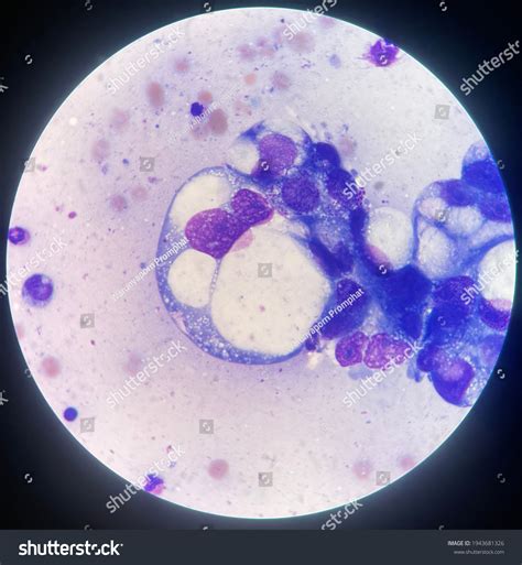 Ascitic Fluid Peritoneal Fluid Analysis Wrights Stock Illustration