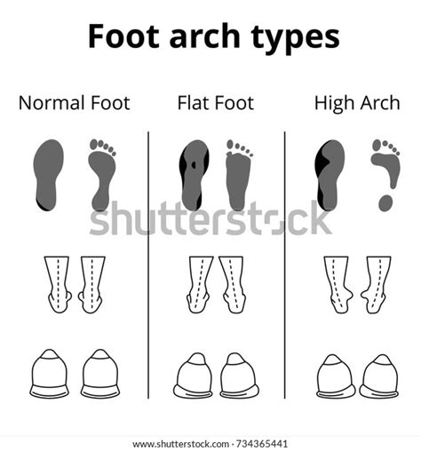 Foot Arch Types Vector Icons Set Stock Vector (Royalty Free) 734365441