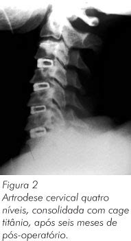 Scielo Brasil Artrodese Cervical Anterior Em Tr S E Quatro N Veis