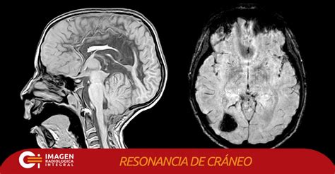 Resonancias Magneticas De Craneo