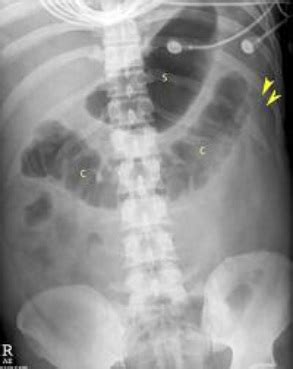 Acute Pancreatitis: Xray - Acute Abdomen Tutorial