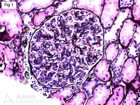 Proliferative Glomerulonephritis With Monoclonal Igg Deposits