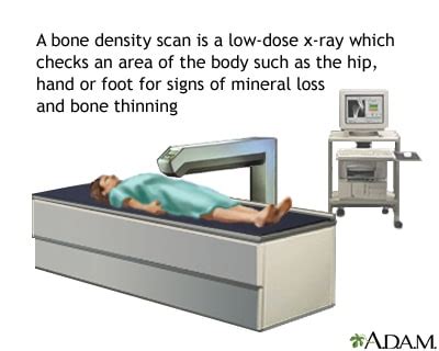 Bone Density Testing for Osteoporosis | In Office Dexa Scans!