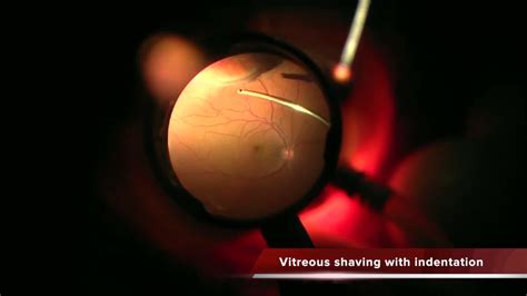 Is Floaters Vitrectomy Safe And Simple Youtube